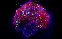 Les tumoroïdes aident à élaborer des traitements anti-tumeurs personnalisés